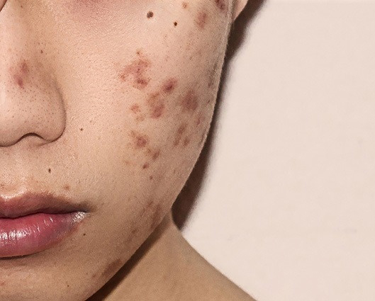 Trị Sẹo Thâm Tại Sen Beauty